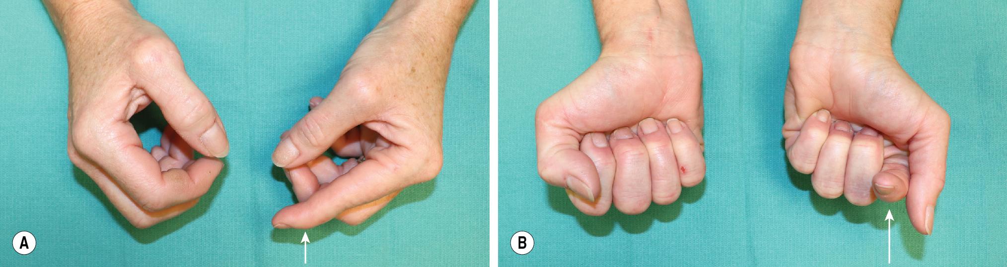 FIGURE 79.1, (A–B) Indication for two-stage flexor tendon reconstruction.