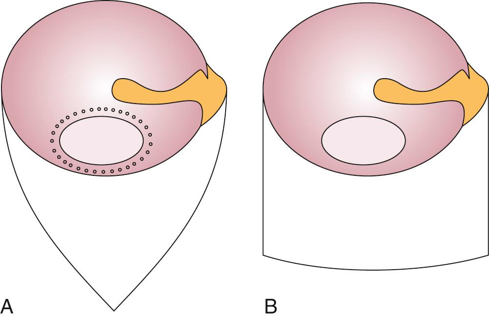 Fig. 142.1, (A) Triangular tympanomeatal flap; perforation edge is prepared for excision by creating small holes along the perimeter. (B) Rectangular tympanomeatal flap.