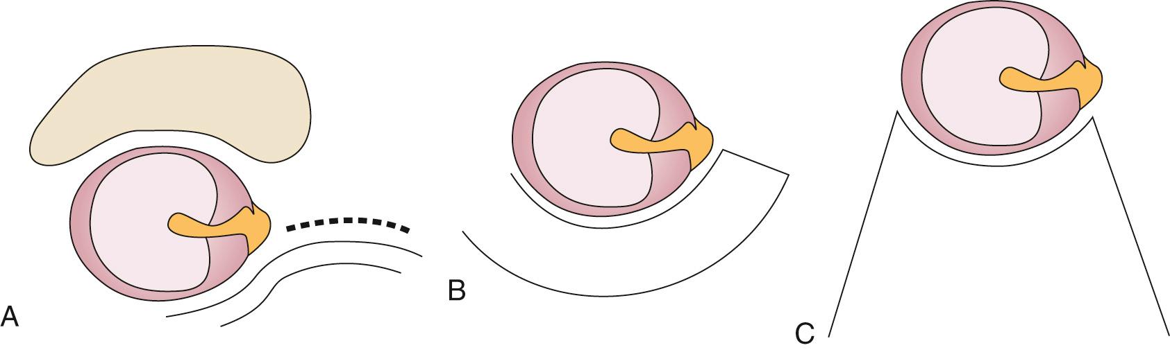 Fig. 142.2, (A) Dashed line shows the vertical limb of the endaural incision starting at 12 o'clock at the bony cartilaginous junction and extending laterally and superiorly into the cartilage-free incisura terminalis, between the superior aspect of the tragus and the root of the helix. (B and C) The vertical limb can be extended medially into the bony canal and may be combined with horizontal incisions to create an inferiorly based skin flap (B) or with incisions along the vascular strip (at 6 o'clock) and lateral to the annulus to create a laterally based Koerner flap (C), which may be extended onto the concha. The vascular strip may also be incised and elevated from a postauricular approach (C).