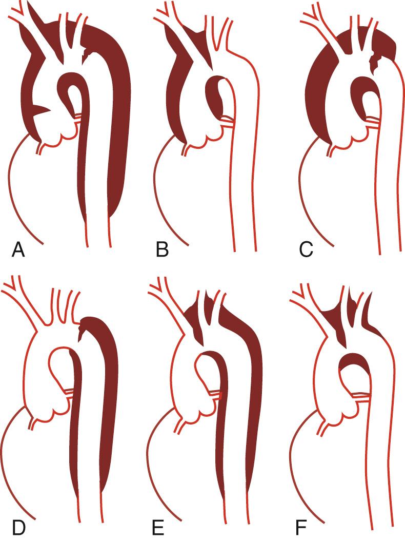 FIGURE 70-1, Schematic illustration of the Stanford classification system of aortic dissections. The three examples in the top row are all type A aortic dissections because the ascending aorta is involved. The primary intimal tear can be located in the ascending aorta (A), in the transverse arch (B), or in the descending thoracic aorta (C). This last example is now called a retro-A dissection and is equivalent to a type III-D dissection. The dissections in (D) and (E) are type B dissections; whether the tear is in the descending thoracic aorta or the arch, the ascending aorta is not involved. The last example (F) is an isolated arch dissection without retrograde or antegrade propagation; these are rare.