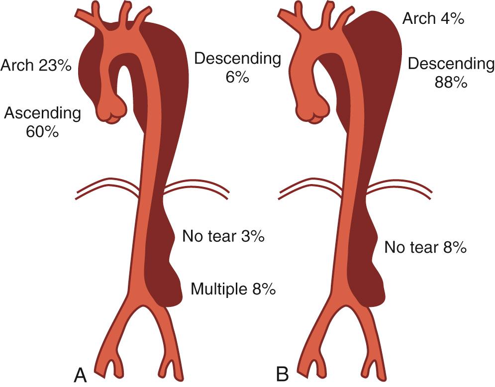 FIGURE 70-3, Location of the primary intimal tear in a series of 168 patients who underwent operative repair of (A) acute type A aortic dissection ( n = 169) and (B) acute type B aortic dissection ( n = 29).