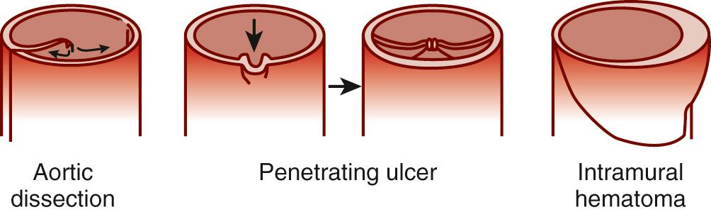 FIGURE 70-4, Schematic illustration of classic aortic dissection with a distinct intimal flap separating the true and false lumens (left), penetrating atherosclerotic ulcer with a localized intimal lesion burrowing into the media and leading in some cases to localized dissection (middle), and intramural hematoma without intimal lesion (right) .