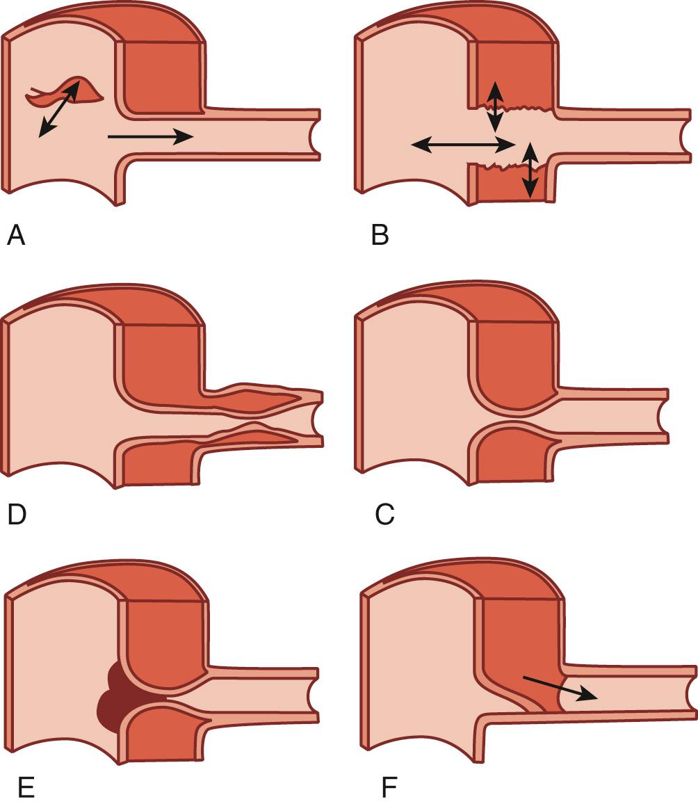 FIGURE 70-5, Examples of branch artery involvement in aortic dissection. Continued adequate perfusion of an aortic tributary is illustrated in (A), (B), and (F); however, perfusion is from the true lumen in (A) and (B) and through the false lumen in (F). Obstruction of an aortic tributary owing to extrinsic compression is shown in (C) and (D), whereas compromise of the ostium of the true lumen with secondary thrombosis is shown in (E). In (F), reentry of the dissection into the branch vessel has created an intimal flap. This can become a permanent situation if the flap heals to the opposite wall of the artery in the chronic phase, thus rendering this branch solely dependent on false lumen perfusion.