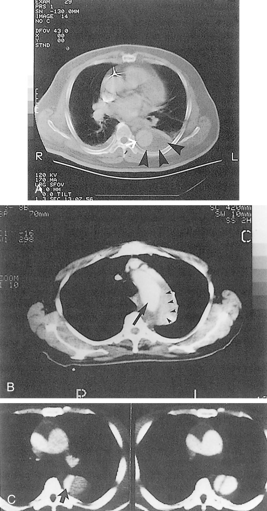 FIGURE 71-2, Examples of diagnostic computed tomography (CT) scans. A, The CT scan shows the linear flap (black lucency, white arrow) between the two aortic lumens in the descending thoracic aorta that is characteristic of aortic dissection. In addition, a relatively large hematoma surrounding the aorta is seen (arrowheads), representing recent hemorrhage contained in the posterior mediastinum. Despite this ominous appearance, this patient did well with medical therapy for more than 1 year until progressive enlargement of a localized false aneurysm prompted referral for operation. B, CT scan from a different patient with an acute type B dissection illustrating a false aneurysm involving the distal arch and proximal descending thoracic aorta. The false lumen (arrowheads) is partially thrombosed; therefore, it opacifies only faintly compared with the contrast seen in the true lumen (arrow). C, Although this patient had a type A dissection (note the deformed true lumen in the large ascending aorta), this CT scan demonstrates differential opacification of the true and false lumens in the descending thoracic aorta. The true lumen (arrow) is completely opacified in the left panel; later in the cardiac cycle (right panel), both true and false lumens are equally opacified.