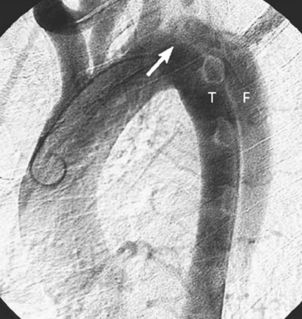 FIGURE 71-3, Aortographic findings in acute type B aortic dissection. The true aortic lumen (T) is extrinsically narrowed by the false lumen (F). The true lumen is characteristically smaller and located medially. Note that the pigtail angiographic catheter has been passed up the true lumen from below. The primary intimal tear (arrow) is located just distal to the left subclavian artery.