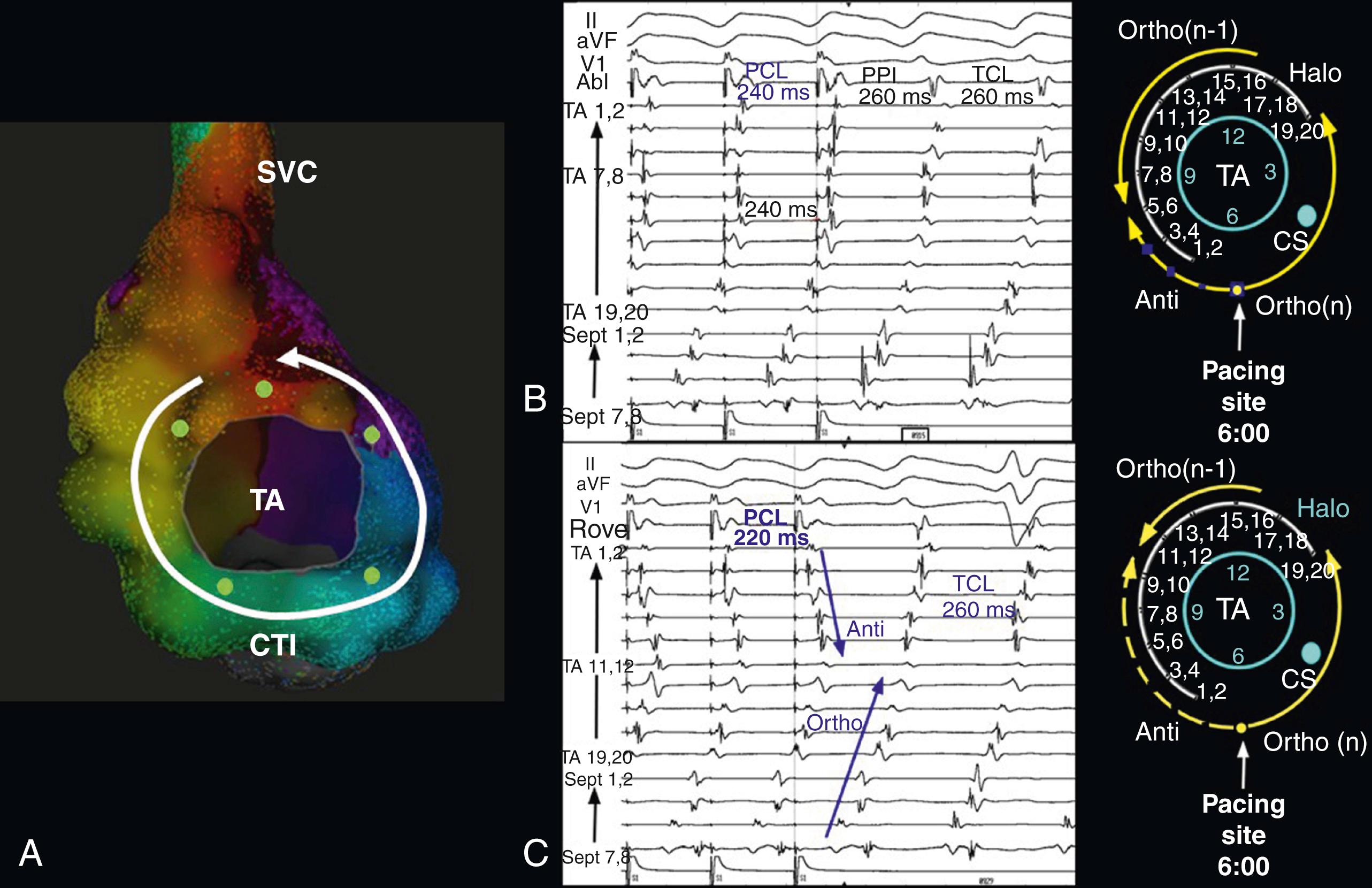 Fig. 78.2, Detailed activation map of typical counterclockwise atrial flutter, with green dots indicating that entrainment is “in” all around the TA.