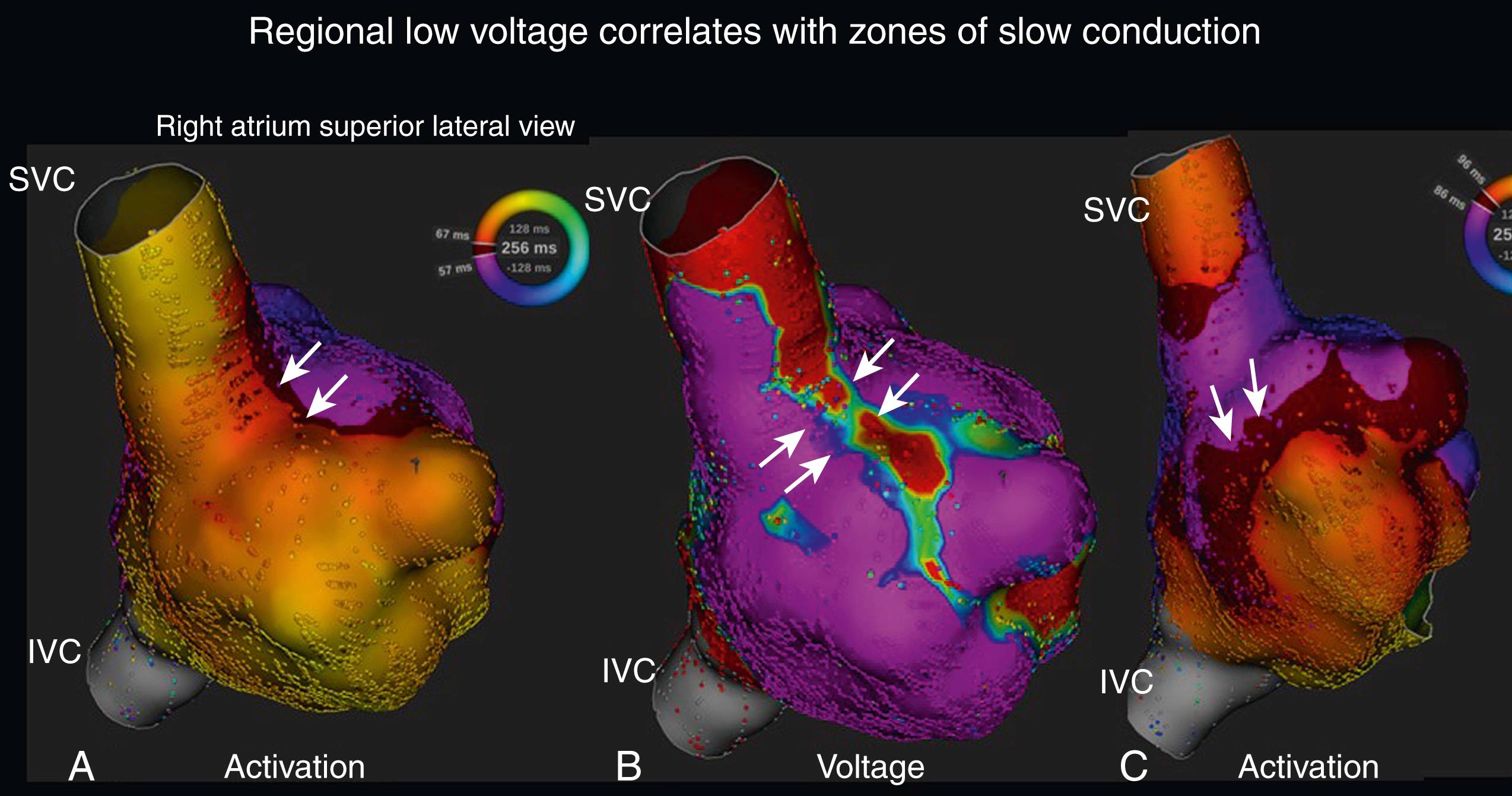 Fig. 78.3, Activation and voltage maps of counterclockwise atrial flutter viewing the right atrium from the superior and lateral aspect (SVC and IVC indicated).