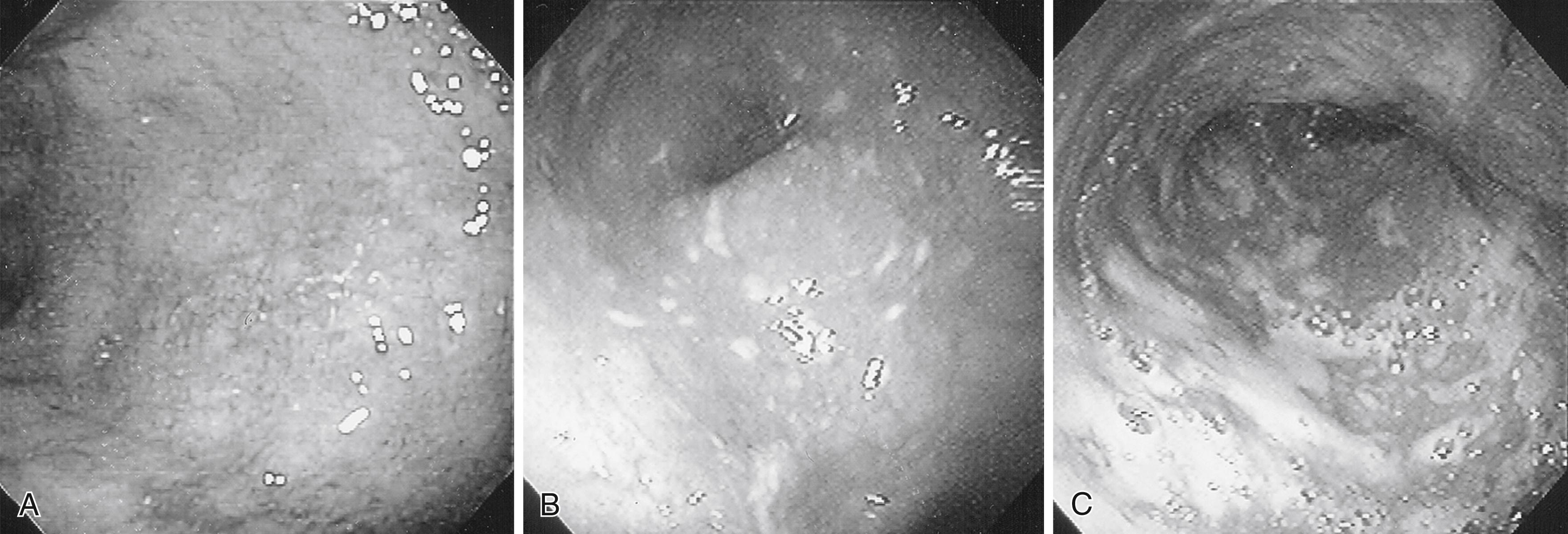 Fig. 43.1, Endoscopic Appearance of the Colon in Ulcerative Colitis.