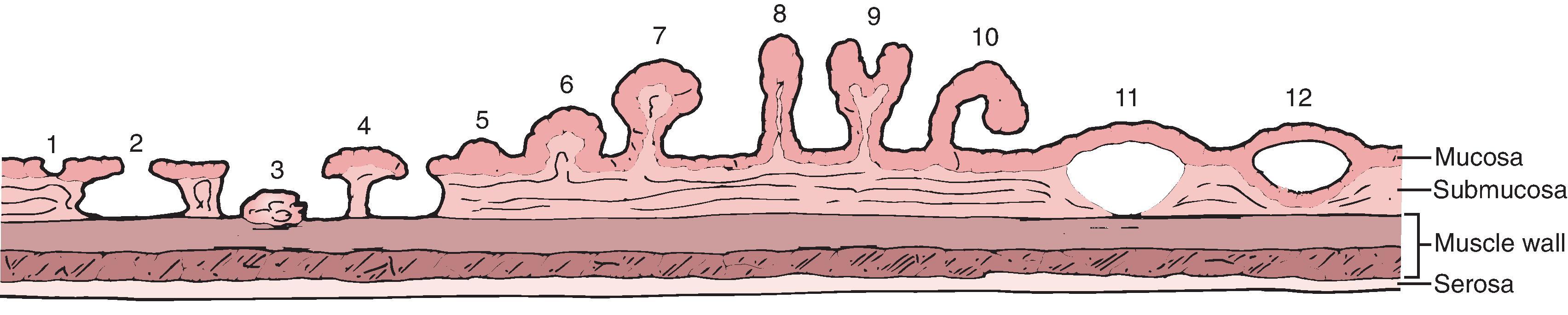 Fig. 41.1, Spectrum of mucosal abnormalities in ulcerative colitis.