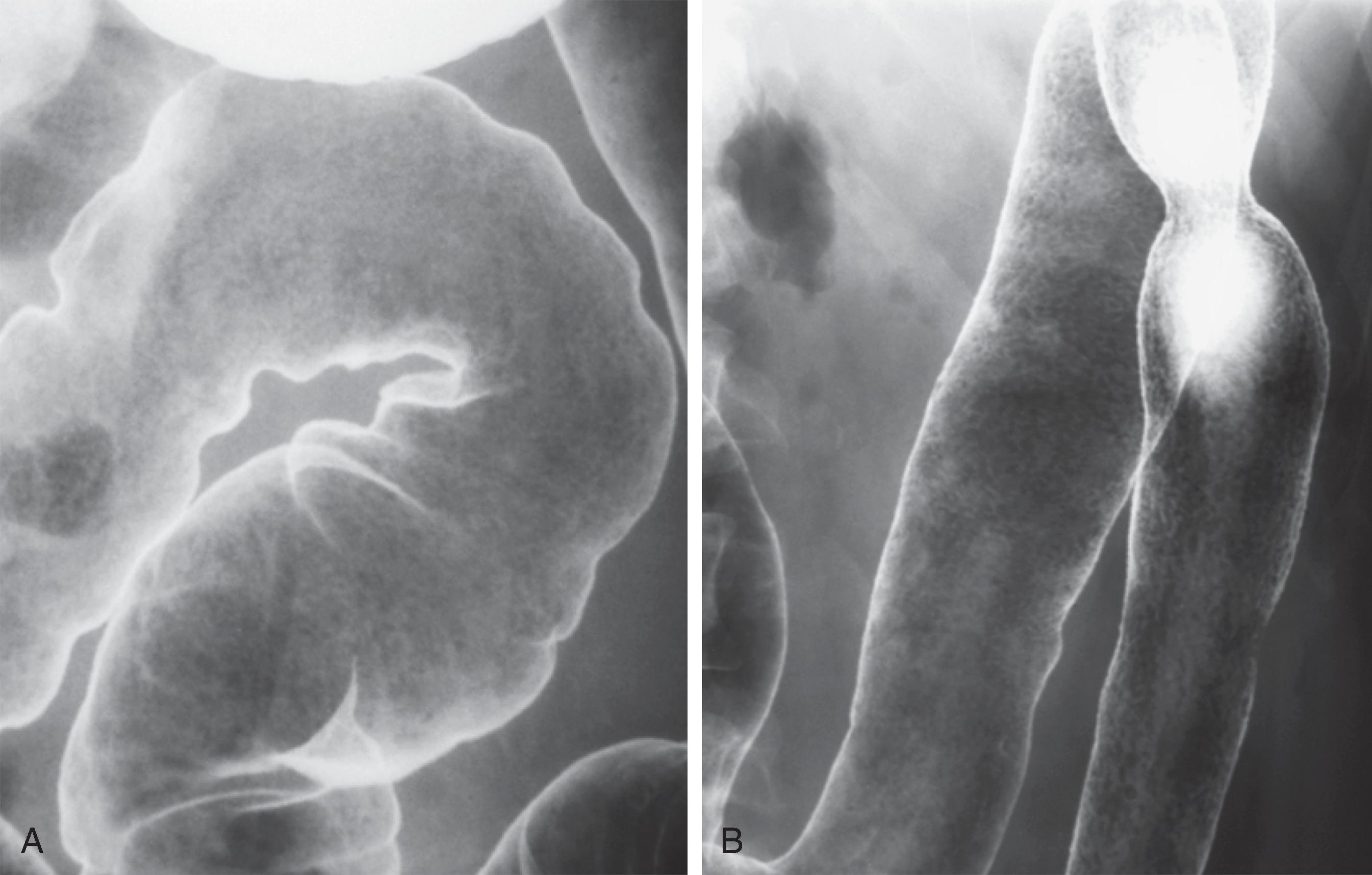 Fig. 41.2, Ulcerative colitis: granular mucosal pattern.