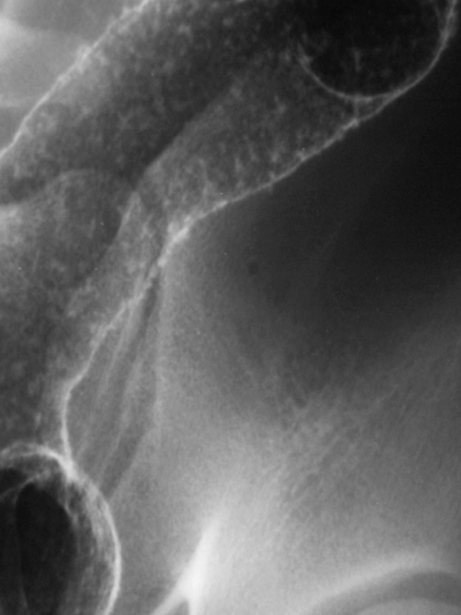 Fig. 41.3, Ulcerative colitis: crypt abscess causing mucosal stippling.