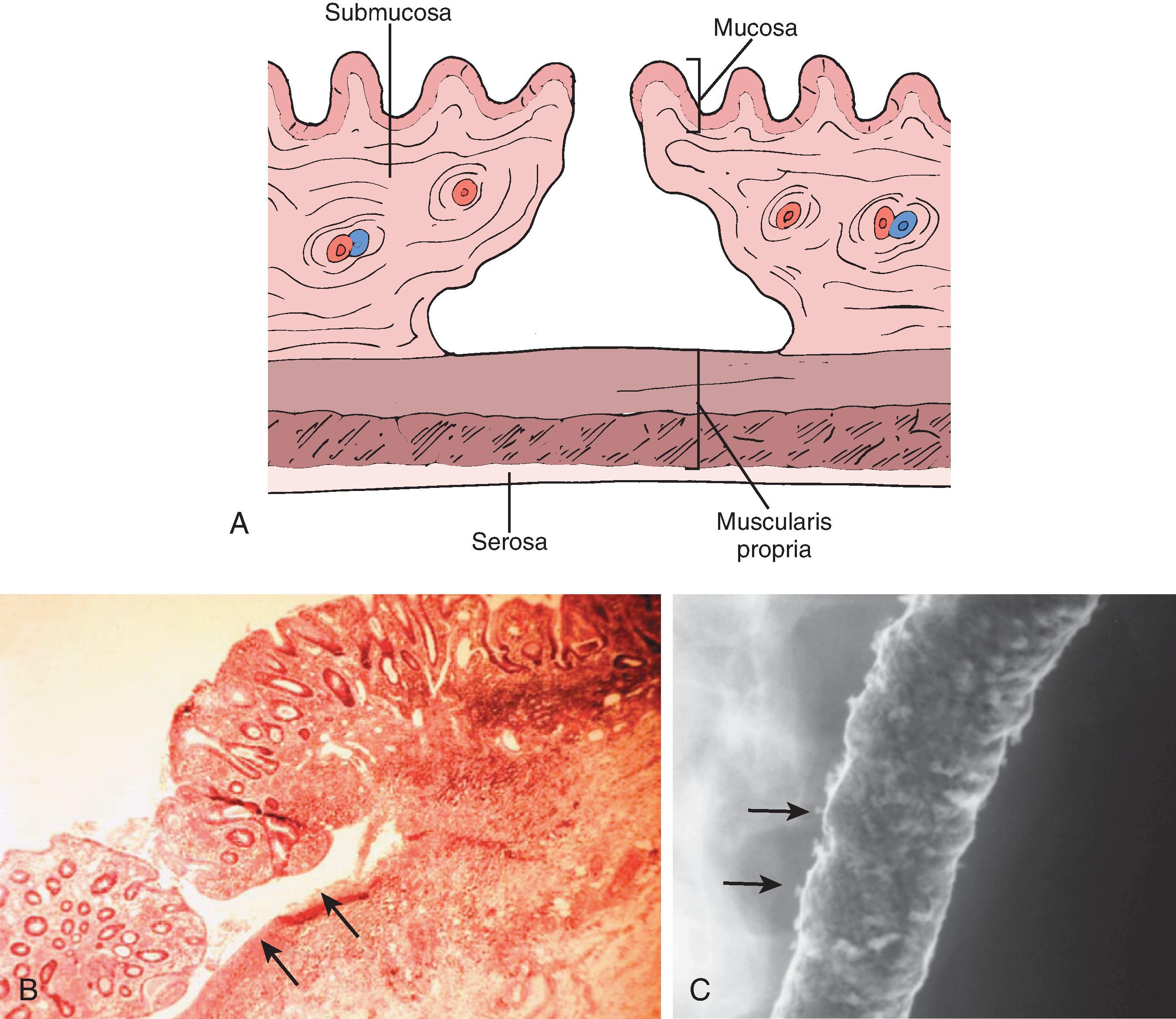 Fig. 41.4, Ulcerative colitis: collar button ulcers.