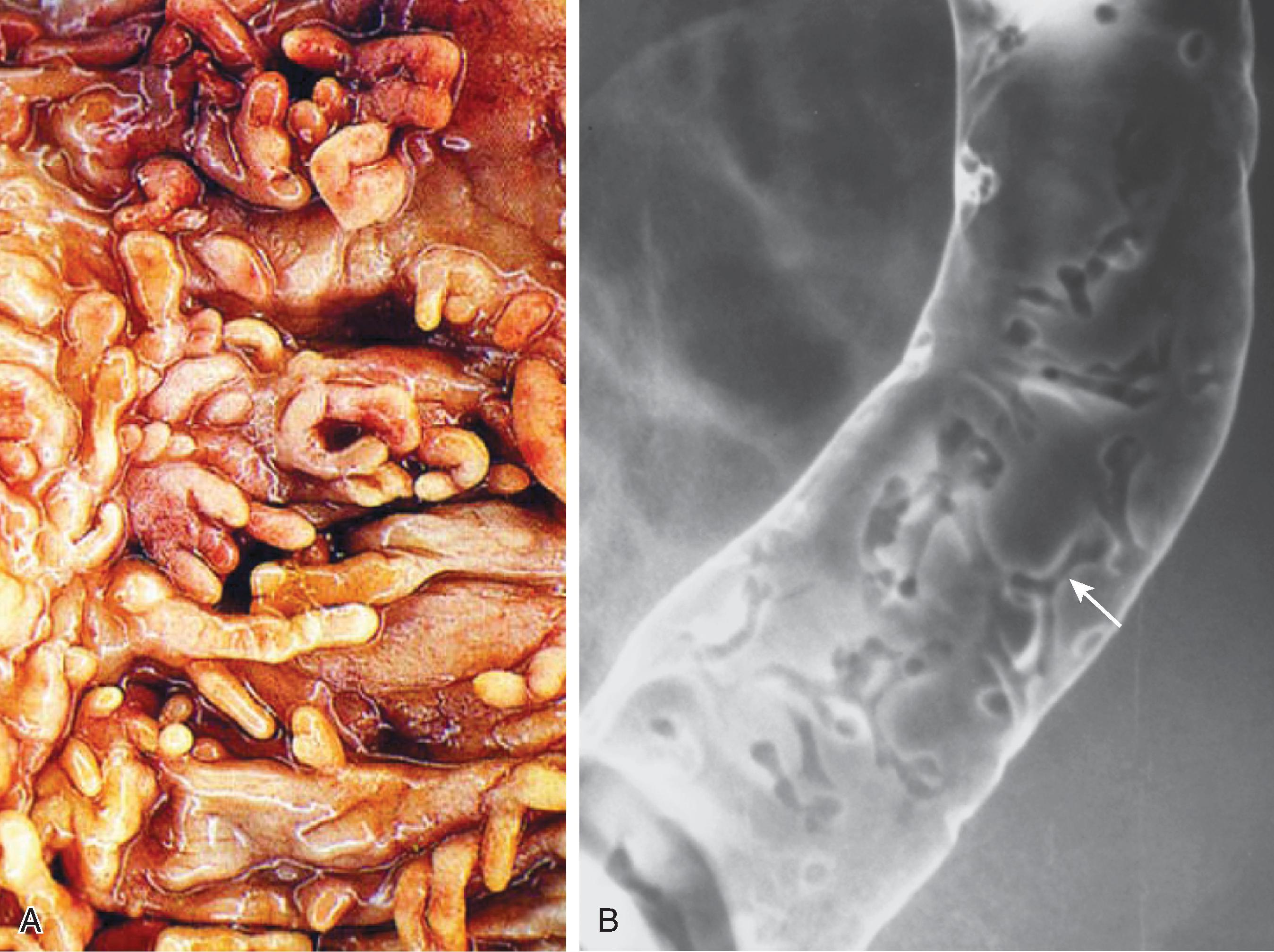 Fig. 41.6, Ulcerative and Crohn’s colitis: postinflammatory pseudopolyps.