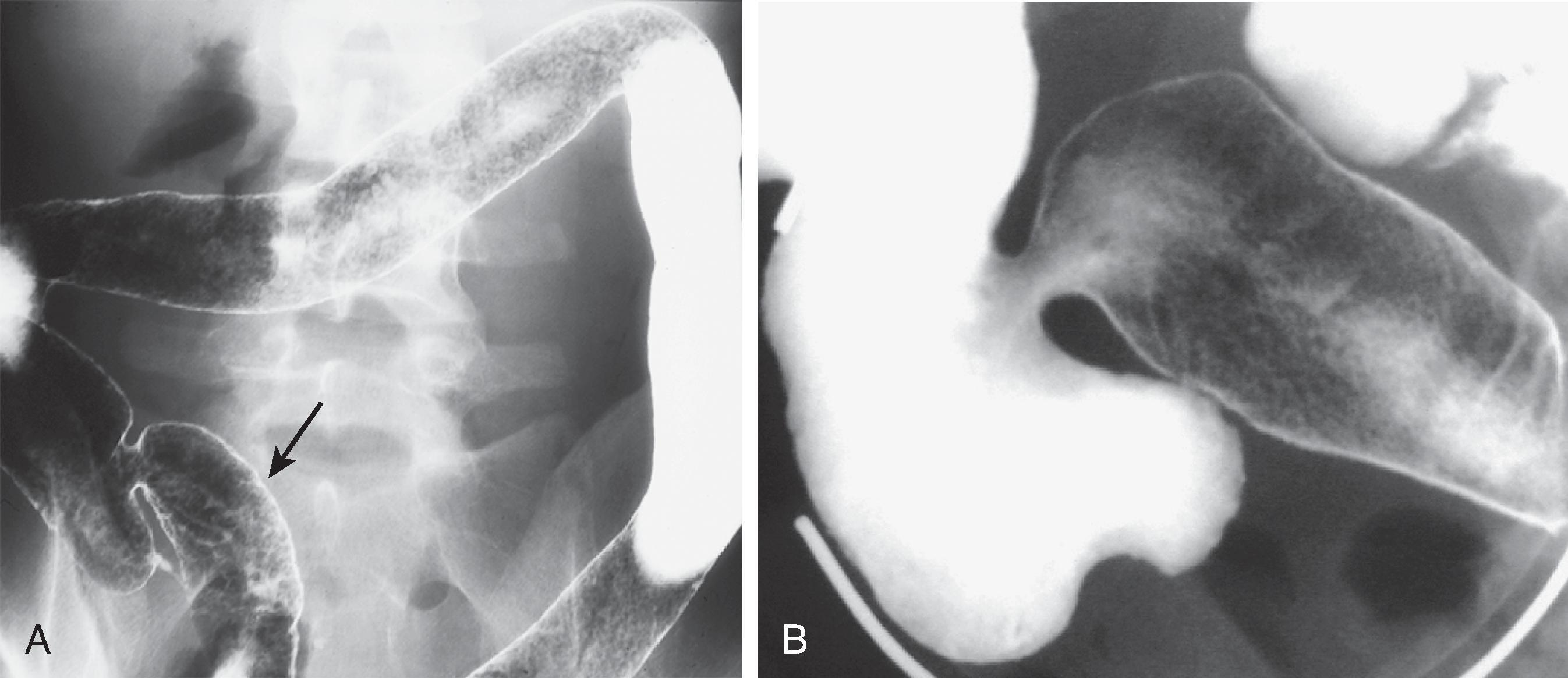 Fig. 41.7, Ulcerative colitis: backwash ileitis.