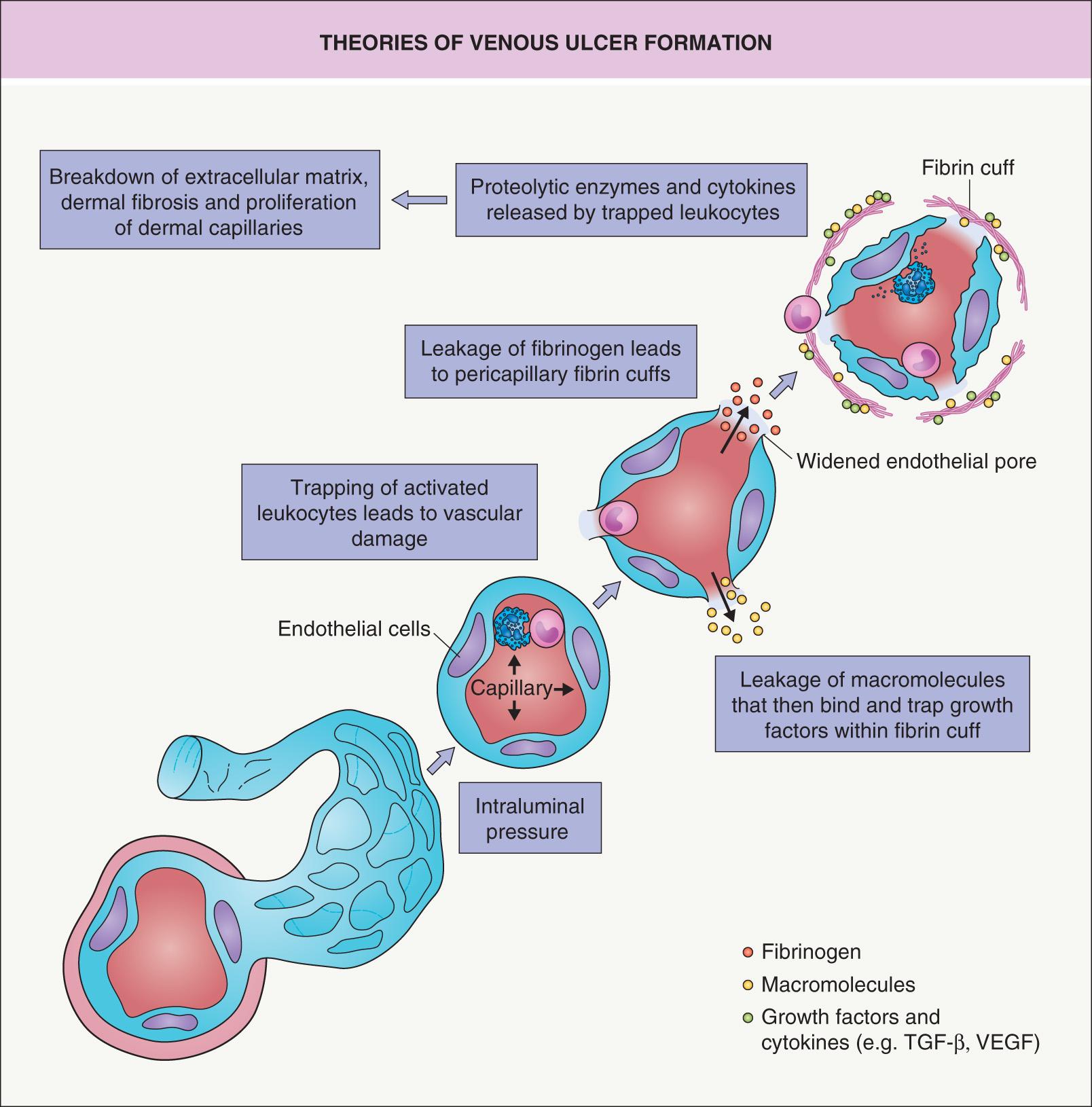 Fig. 105.3, Theories of venous ulcer formation.