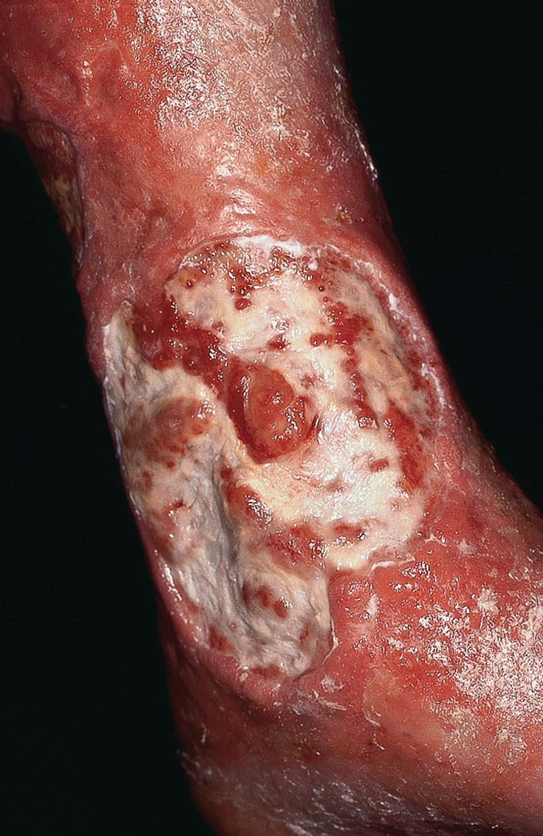 Fig. 105.4, Venous ulcer and stasis dermatitis.