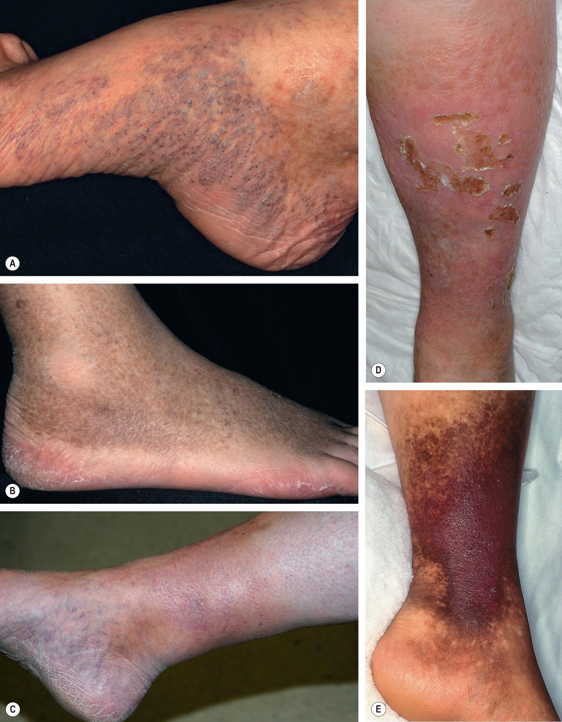 Fig. 105.5, Associated findings in patients with venous hypertension and venous insufficiency.