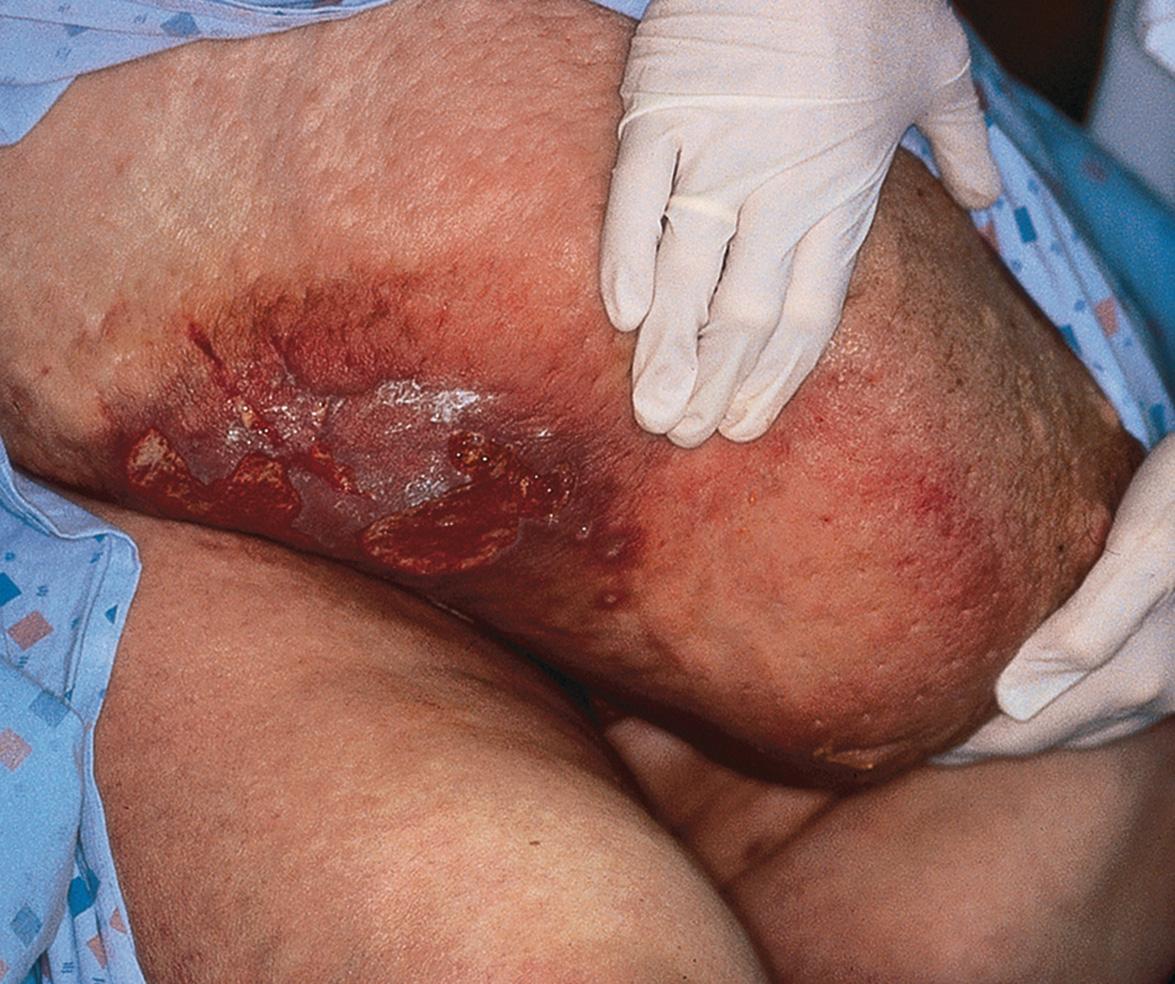 Fig. 105.6, Lipodermatosclerosis, chronic ulceration and lymphedema of the dependent portion of the pannus.