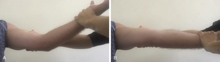 • Fig. 37.2, Bounce home test: patient’s elbow is flexed slightly (A) and then brought to full extension, swiftly pulling down at the wrist to bring the elbow into extension (B). Positive with pain on extension.