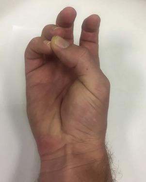 • Fig. 37.3, Identify the presence of a palmaris tendon by pinching the thumb and little finger together and slightly flexing the wrist.