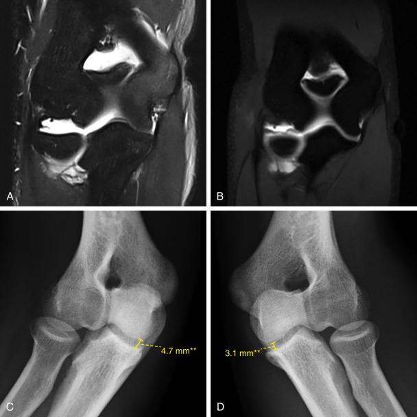 • Fig. 37.4, Stress radiography to evaluate for ulnar collateral ligament (UCL) injury. Magnetic resonance imaging (MRI) at initial evaluation demonstrated a proximal (UCL) tear (A). Following treatment with platelet rich plasma, a repeat MRI 8 months later demonstrated a healed UCL (B). Because of a continued inability to pitch, however, the patient underwent stress x-rays which showed medial gapping of the injured elbow (C) compared to the non injured elbow (D).