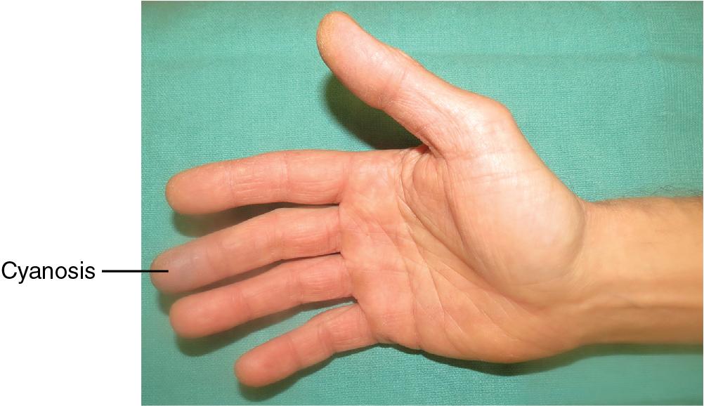 FIGURE 97.1, Physical examination findings in ulnar artery occlusion can range from normal to subtle color and temperature changes (pictured here) to ulcerations and frank tissue loss.