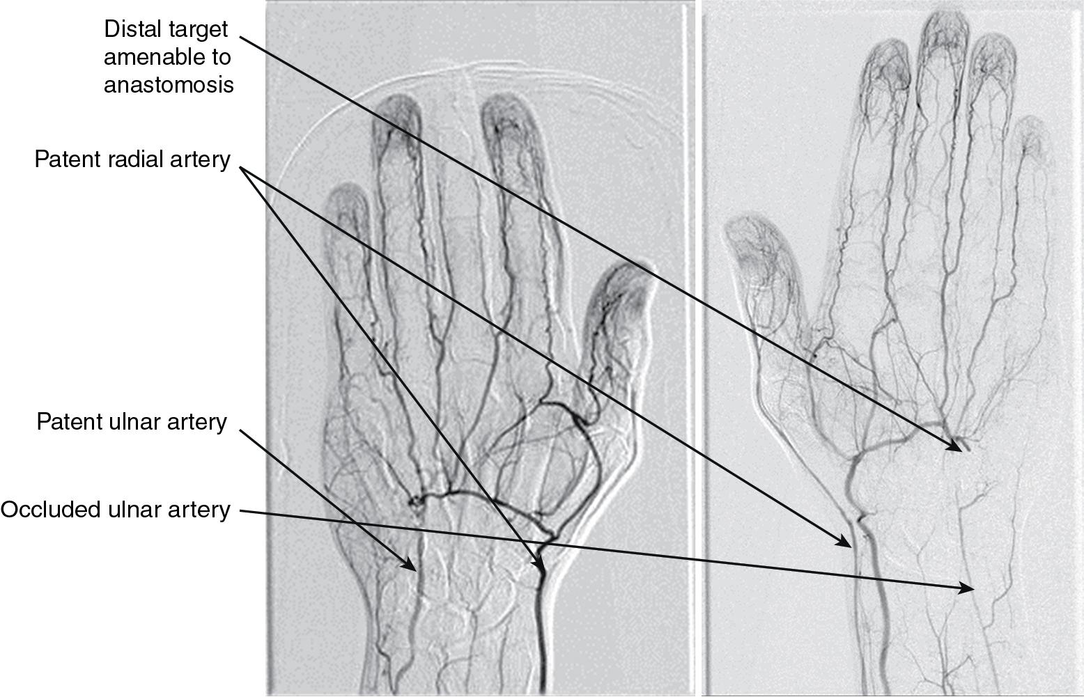 FIGURE 97.2, Two angiograms exhibiting ulnar artery occlusion, with no clear distal target on left , and a clear distal target on right .