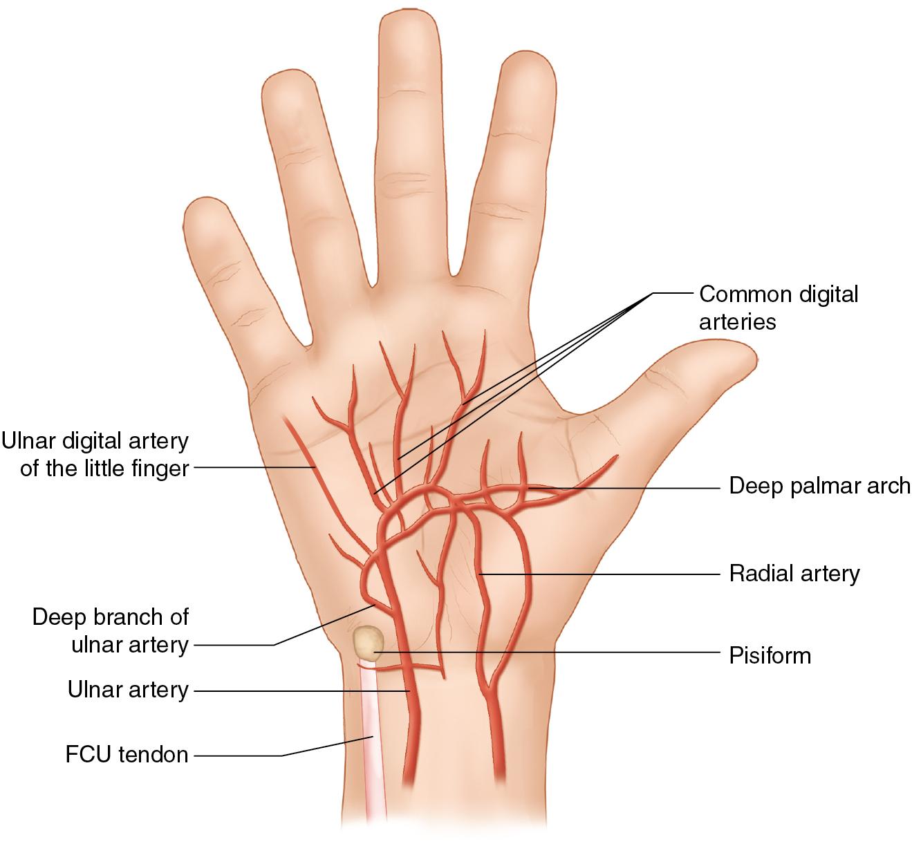 FIGURE 97.3, The superficial arch, and therefore the ulnar artery, gives rise to the finger’s digital arteries. The ulnar artery gives off the ulnar digital artery to the little finger and three common digital arteries at the level of the metacarpophalangeal joint.