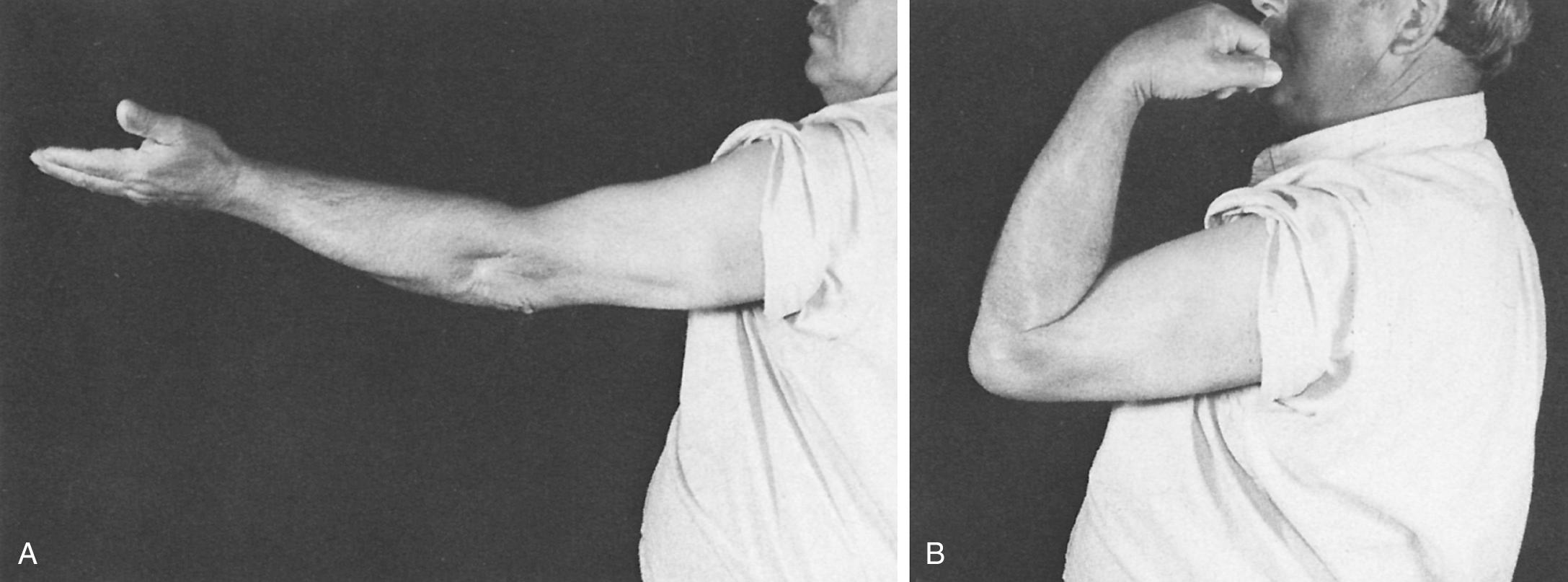 FIG 111.1, (A) and (B) Primary elbow arthrosis usually presents with loss of extension in men older than 40 years of age. Most often flexion and extension are in the functional range.