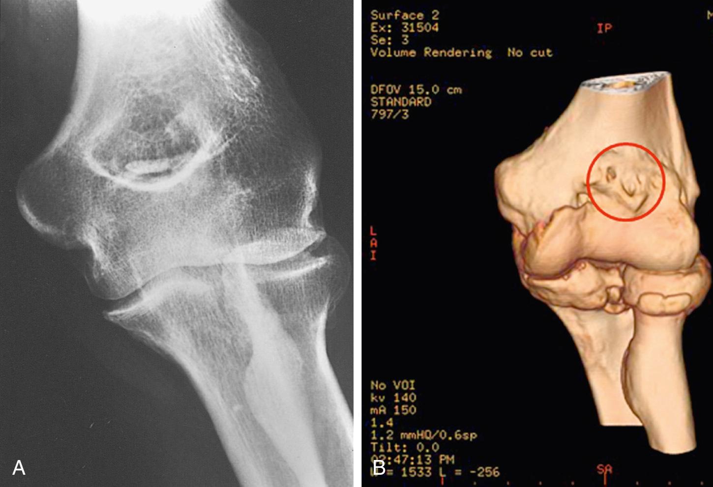 FIG 111.3, (A) Anteroposterior roentgenogram of the elbow demonstrating ossification of the olecranon fossa. (B) The three-dimensional reconstructed CT image demonstrates the extent of ossification of the humeral fossae and explains the effectiveness of removing the bone indicated.