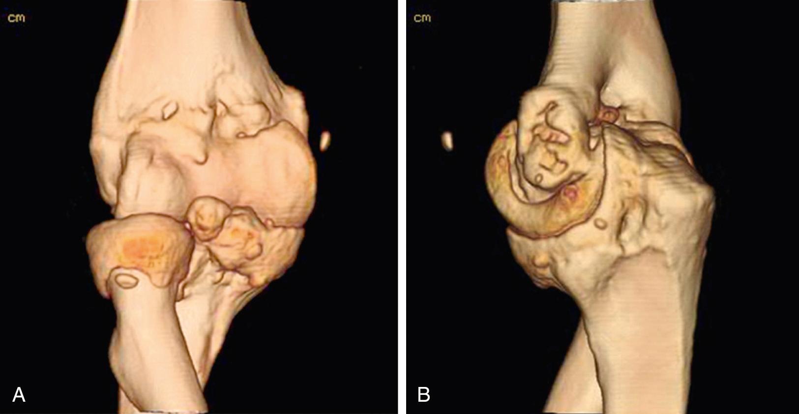 FIG 111.4, This three-dimensional CT image clearly demonstrates the marginal osteophyte formation anteriorly (A) and posteriorly (B) as well as the ossification of the fossae.