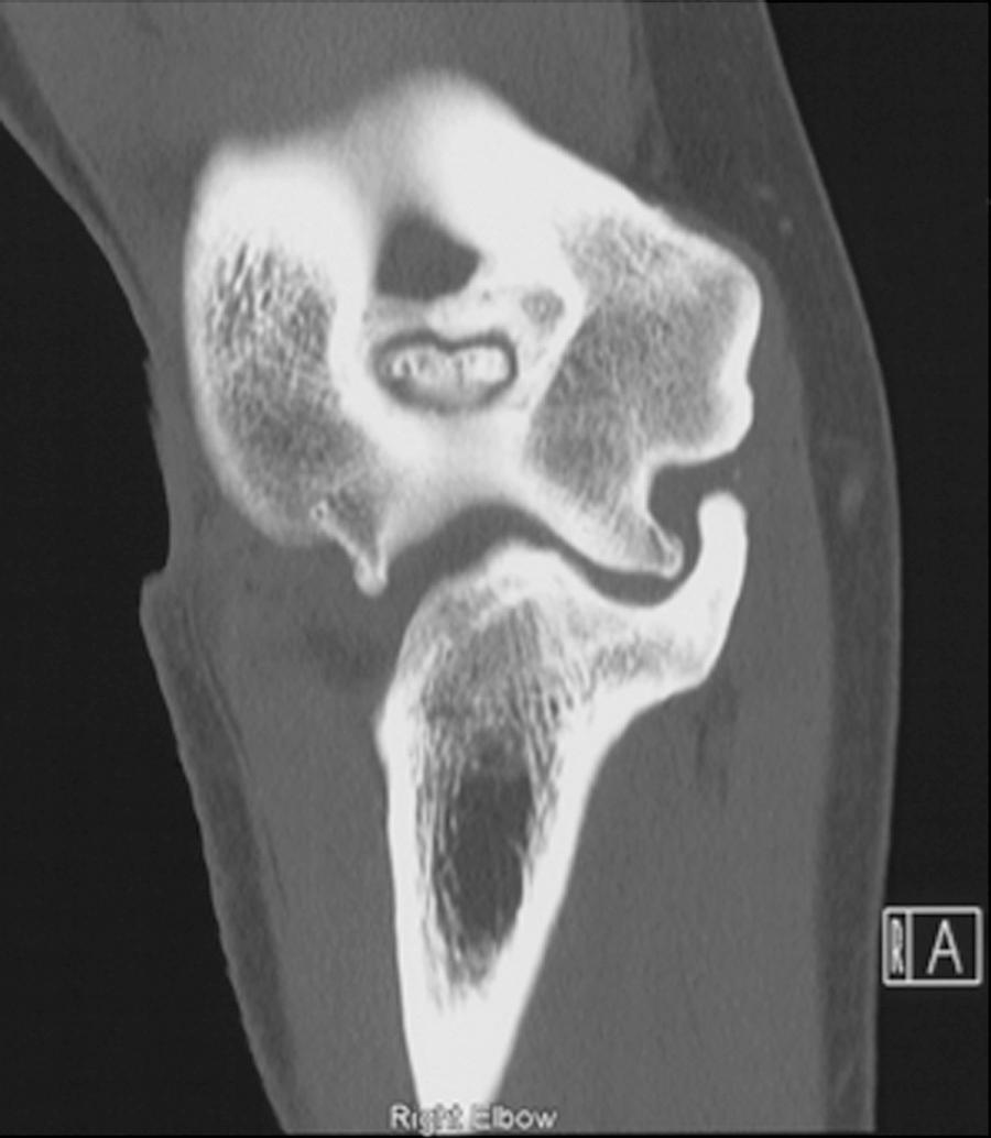 FIG 111.5, The CT image demonstrates a large osteophyte encroaching on the cubital tunnel, a clear source of ulnar nerve symptoms.