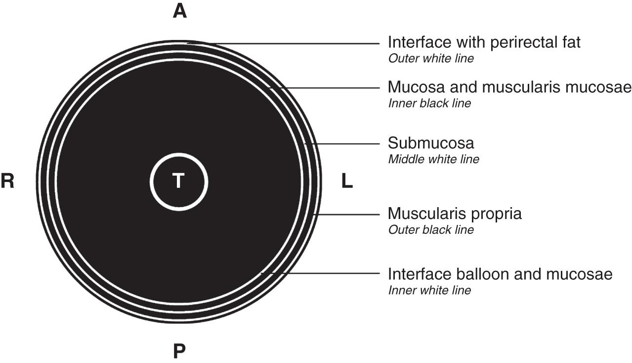 FIGURE 147.1, Five-layer anatomic model for interpretation of endorectal ultrasonographic scans. Three hyperechoic (white) layers and two hypoechoic (black) layers. A , Anterior; L, left; P , posterior; R, right; T, transducer.