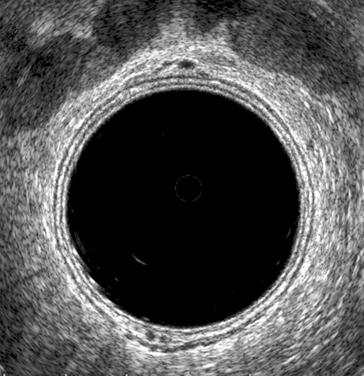 FIGURE 147.2, Normal rectal wall. Hypoechoic lines (black) represent the inner muscularis mucosae and the outer muscularis propria. Hyperechoic lines (white) represent the interfaces between the balloon (inner), submucosa (middle), and perirectal fat (outer). The seminal vesicles are seen anteriorly as bilateral hypoechoic (black) structures.