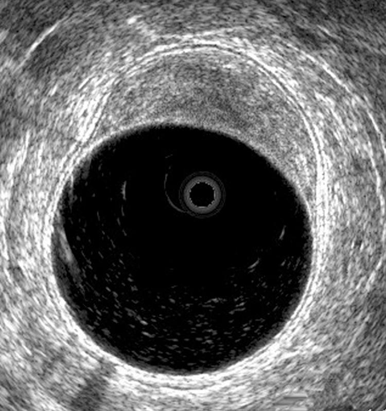 FIGURE 147.3, Benign villous tumor of the rectum (uT0). The middle white line is intact, indicating that the submucosa is not involved.