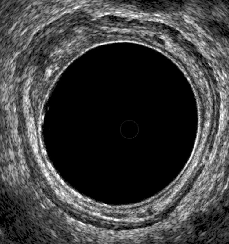 FIGURE 147.5, uT2 lesion. The middle white line is disrupted and there is expansion of the outer black line , indicating invasion of the tumor through the submucosa and into the muscularis propria. The outer white line is intact, indicating that the tumor is confined to the rectal wall.