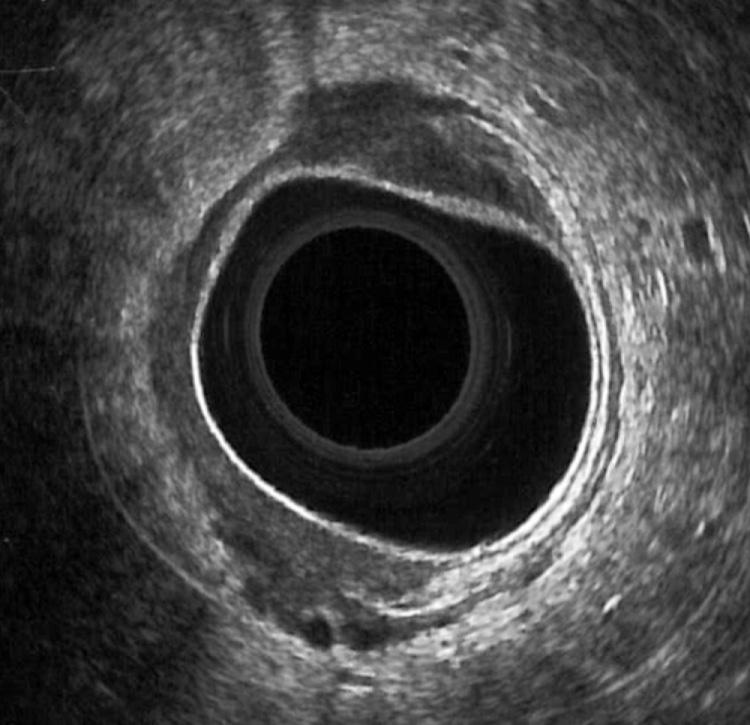 FIGURE 147.6, uT3 lesion. The outer white line is irregular and interrupted, indicating tumor invasion into the perirectal fat.