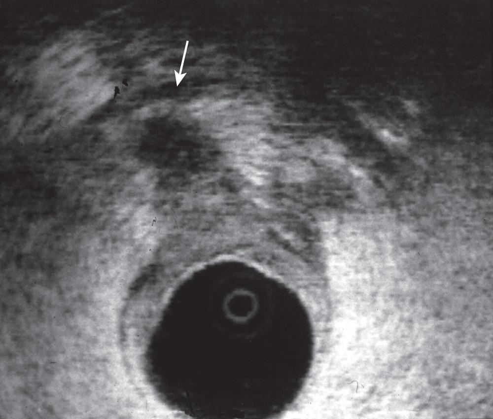 FIGURE 147.7, uT4 lesion. Tumor invades the posterior vaginal wall (arrow) .