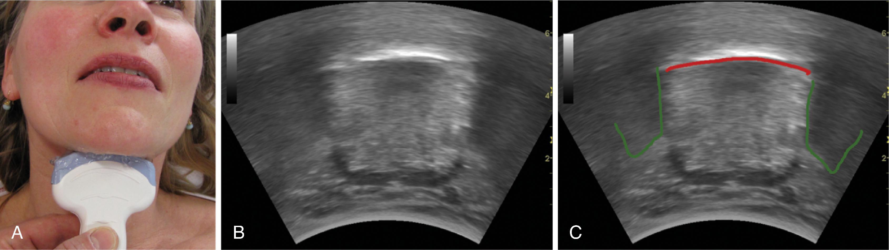 Fig. 3.2, Transverse scan of the floor of the mouth and the tongue. (A) Placement of the transducer. (B) The scanning image. (C) The dorsal surface of the tongue is indicated by a red line , and shadows arising from the mandible are outlined in green .