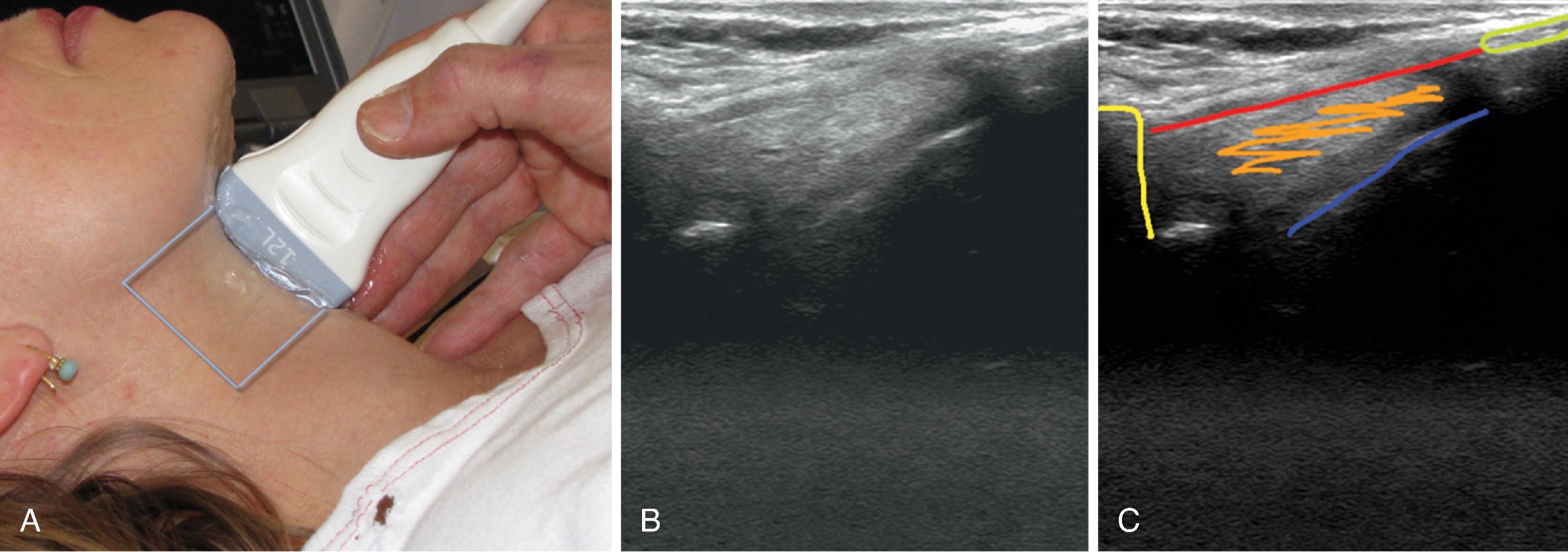 Fig. 3.5, Midline sagittal scan from the hyoid bone to the proximal part of the thyroid cartilage. (A) The light blue outline shows the area covered by the scan. (B) The scanning image. (C) The shadow from the hyoid bone is marked in yellow , the thyrohyoid membrane in red , the posterior surface of part of the epiglottis in blue , the preepiglottic fat in orange , and the thyroid cartilage in green .