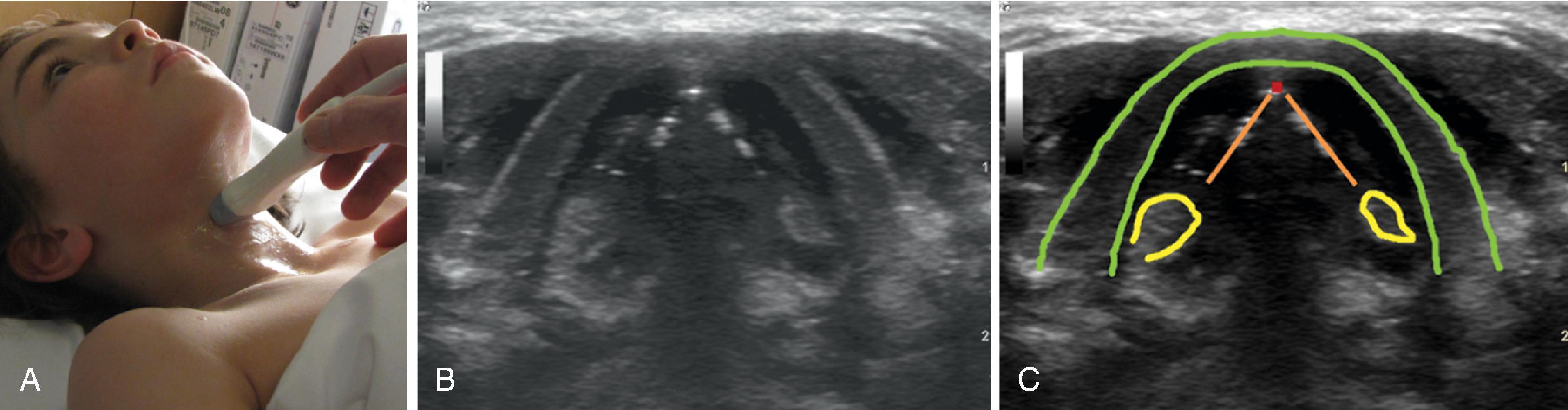 Fig. 3.6, Transverse midline scan over the thyroid cartilage in an 8-year-old boy. (A) Placement of the transducer. (B) The scanning image. (C) The thyroid cartilage is marked in green , the vocal cords in orange , the anterior commissure in red , and the arytenoid cartilages in yellow .