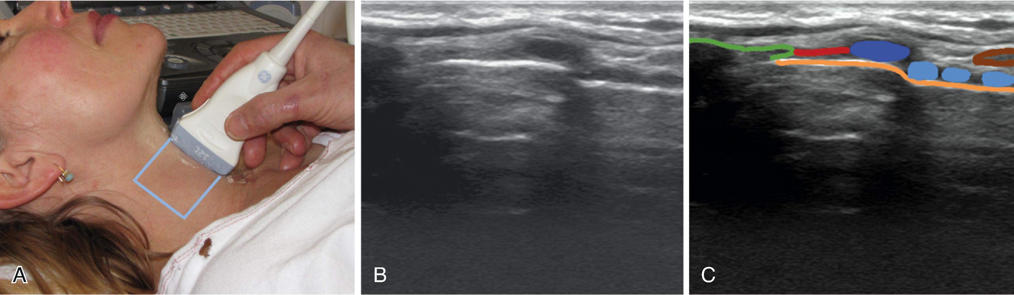 Fig. 3.7, Cricothyroid membrane (CTM). (A) The linear high-frequency transducer is placed in the midsagittal plane. The scanning area is marked with light blue . (B) The scanning image. (C) The thyroid cartilage is marked in green , the cricoid cartilage in dark blue , the tracheal rings in light blue , the CTM in red , the tissue-air border in orange , and the isthmus of the thyroid gland in brown . Below the orange line , only artifacts are seen.