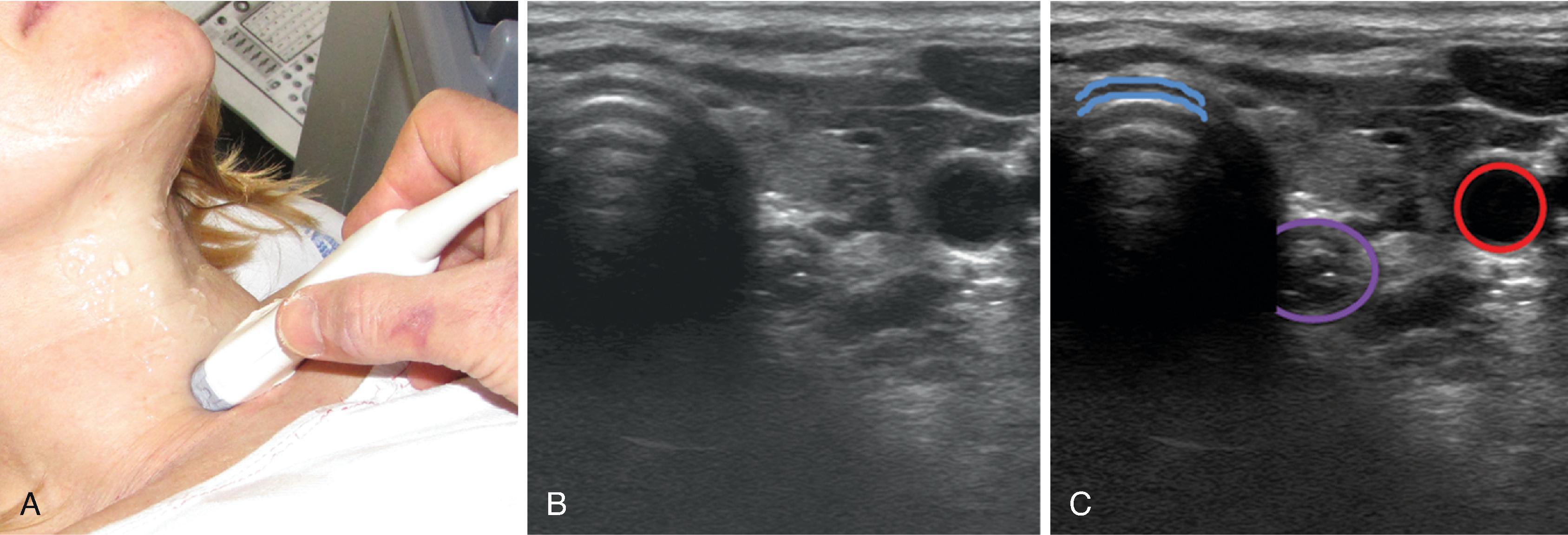 Fig. 3.8, Trachea and esophagus. (A) A transverse scan is performed just cranial to the suprasternal notch and to the left side of the patient’s trachea. (B) The scanning image. (C) The anterior part of the tracheal cartilage is outlined in light blue , the esophagus in purple , and the carotid artery in red .