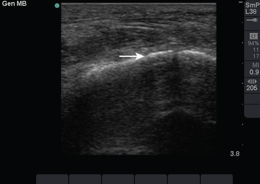 Figure 66.2, This image demonstrates the cortex of a bone (arrow), which appears white, or hyperechoic, when viewed with ultrasound.