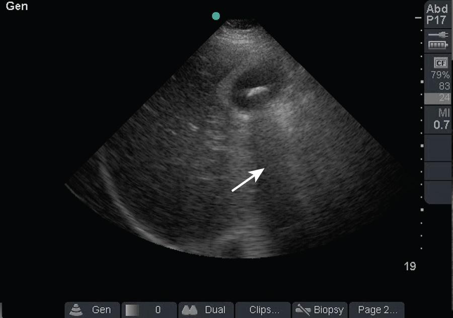 Figure 66.4, Acoustic shadowing (arrow) occurs when ultrasound encounters a hyperechoic, or hard, object. All the sound waves are returned to the transducer, which results in absence of information behind the hyperechoic object.