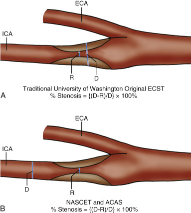 FIG. 7.1, Methods of measuring the degree of internal carotid artery ( ICA ) stenosis at contrast angiography. (A) On top, the older or so-called University of Washington method compares residual lumen ( R ) with original luminal diameter ( D ). Both measurements are taken at the level of the stenosis itself. This measurement was also used in the European Carotid Surgery Trial ( ECST ). As the original lumen cannot be seen on a contrast angiogram, the exact location is difficult to determine and is estimated. (B) On the bottom, the North American Symptomatic Carotid Endarterectomy Trial ( NASCET ) or the Asymptomatic Carotid Atherosclerosis Trial ( ACAS ) method compares R with the distal internal carotid artery D. This is currently the only recognized method for measuring ICA stenosis severity on catheter arteriography as well as magnetic resonance angiography (MRA) and computed tomographic angiography (CTA). ECA, External carotid artery.