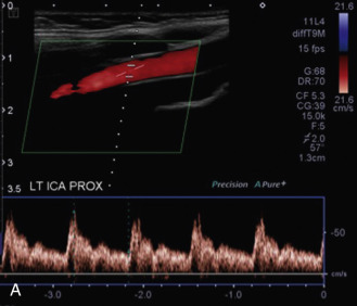 FIG. 7.3, Internal carotid artery ( ICA ) versus external carotid artery ( ECA ) waveforms. The ICA (A) demonstrates a low-resistance pattern with robust diastolic flow because it is supplying the brain. The ECA (B) demonstrates a high-resistance waveform and low diastolic flow.