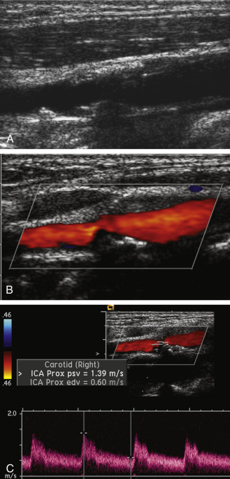 FIG. 7.5, Moderate (50% to 69%) internal carotid artery ( ICA ) stenosis in an asymptomatic 73-year-old man, undergoing precoronary artery bypass surgery. (A) Gray-scale image shows a moderate amount of soft and calcific plaque in the right carotid bulb, extending into the proximal ICA. (B) Color Doppler image suggests a greater degree of stenosis than was apparent on the gray-scale images. (C) Spectral Doppler suggests a 50% to 69% stenosis based on mildly elevated peak-systolic velocity ( PSV = 139 cm/s) and end diastolic velocity ( EVD = 60 cm/s). PSV ratio was also elevated to 2.4. All three parameters are consistent with a 50% to 69% stenosis according to the Society of Radiologists in Ultrasound (SRU) consensus criteria.