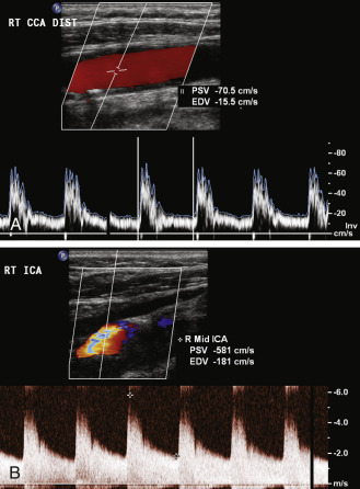 FIG. 7.6, Severe (≥70%) internal carotid artery ( ICA ) stenosis in a 66-year-old man with history of multiple transient ischemic attacks (TIAs) referable to the right hemisphere. (A) Spectral Doppler image of the distal right common carotid artery ( CCA ) demonstrates a peak systolic velocity ( PSV ) of 70.5 cm/s. (B) Color Doppler image from the ipsilateral ICA shows a dense calcific plaque with posterior acoustic shadowing beyond which is an area of intense color aliasing suggesting elevated velocities. Spectral Doppler image confirms marked velocity elevation: PSV = 581 cm/s, end diastolic velocity ( EDV ) = 181 cm/s, and the PSV ratio is 8.2. All three parameters are consistent with a 70% or greater stenosis according to the Society of Radiologists in Ultrasound (SRU) consensus criteria.