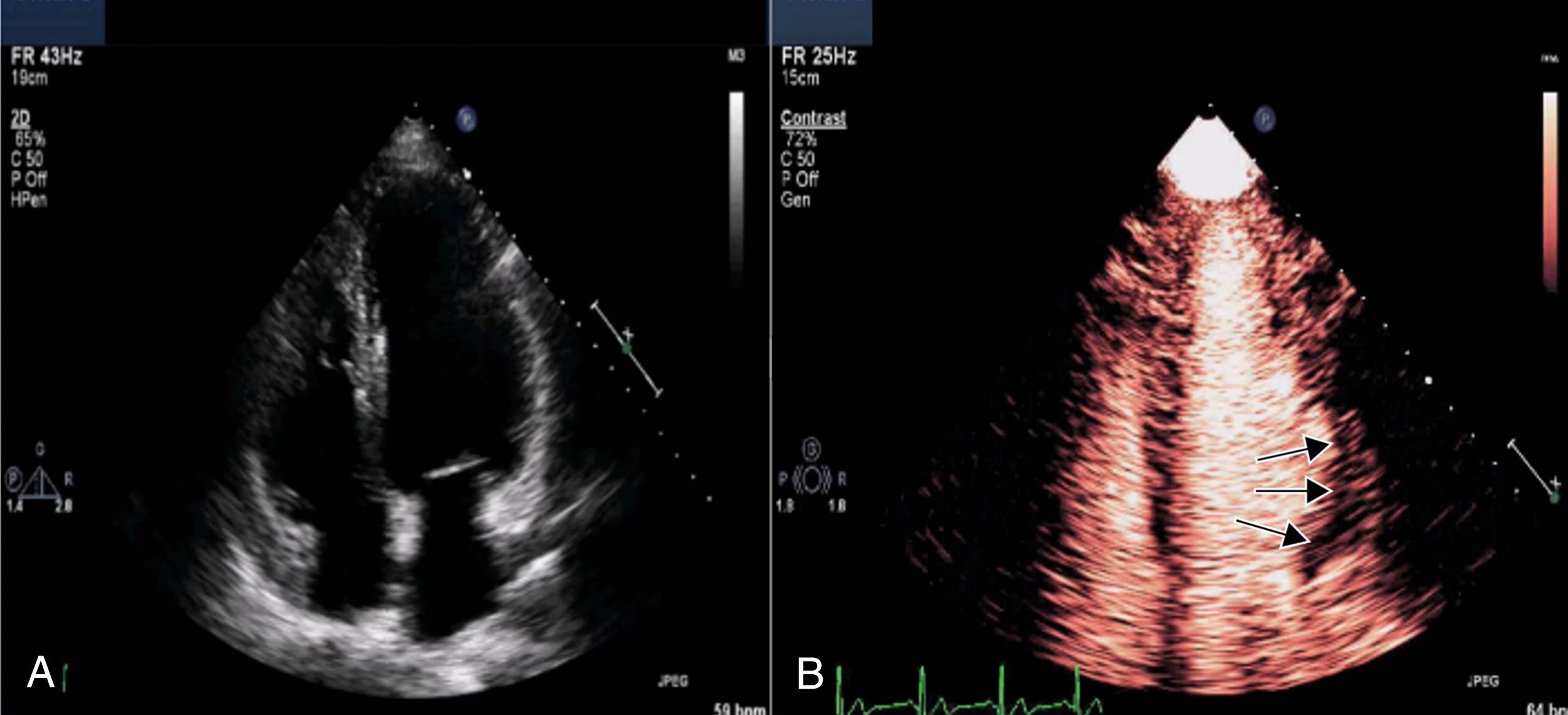 Figure 55.1, Unenhanced apical four-chamber view ( A ) and enhanced image during a continuous infusion of an ultrasound-enhancing agent using fundamental nonlinear imaging (transmit, 1.8 MHz; receive, 1.8 MHz; B ). The end-systolic images are obtained during replenishment of myocardial contrast at three seconds post high–mechanical index impulse. A basal anterolateral perfusion defect and wall thickening abnormality are evident (arrows) . (See corresponding Video 55.1A , Video 55.1B .)